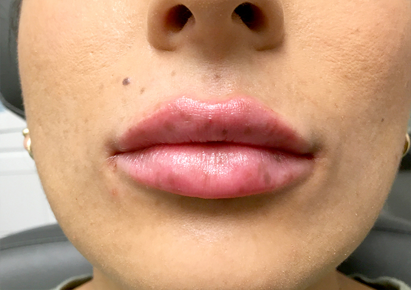 Injectables And Fillers 130