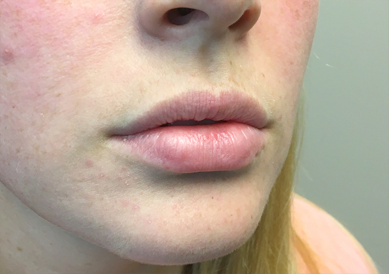 Injectables And Fillers 03