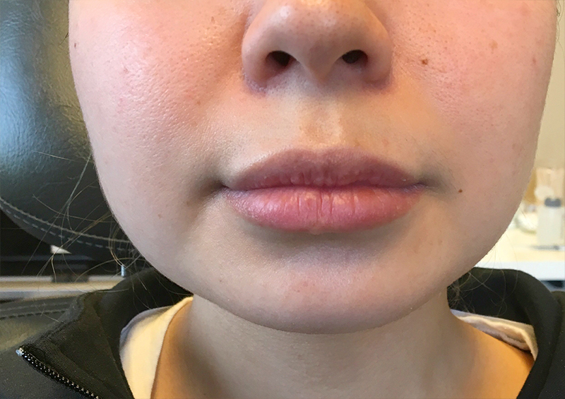 Injectables And Fillers 01