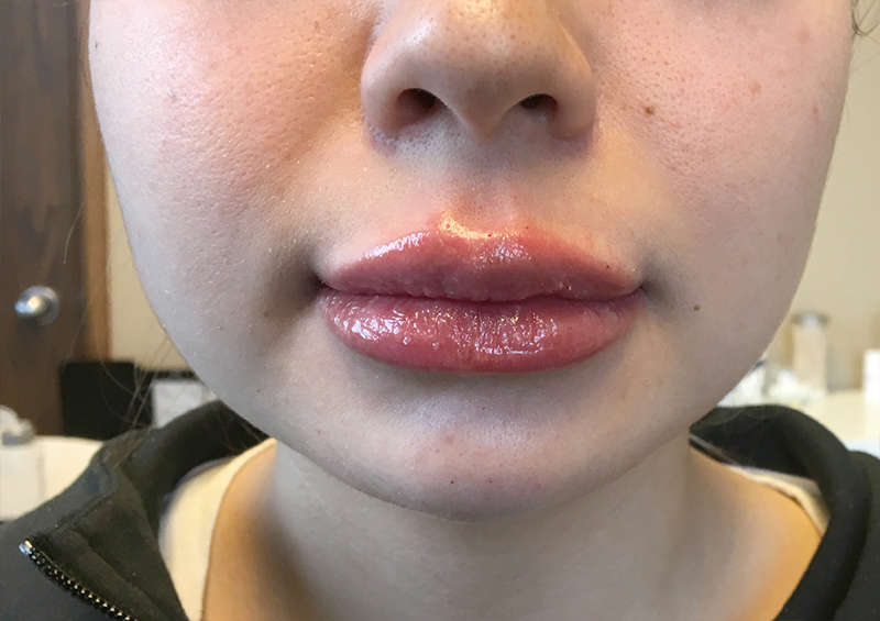 Injectables And Fillers 133