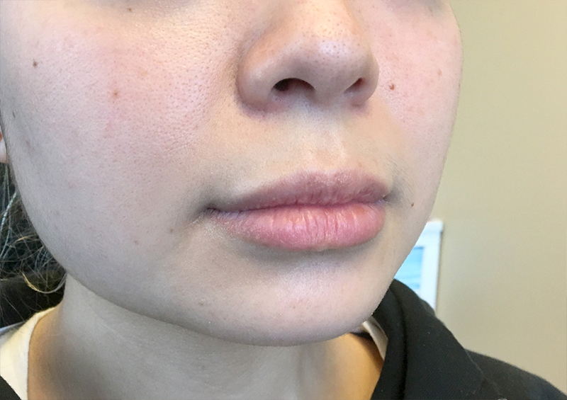 Injectables And Fillers 03