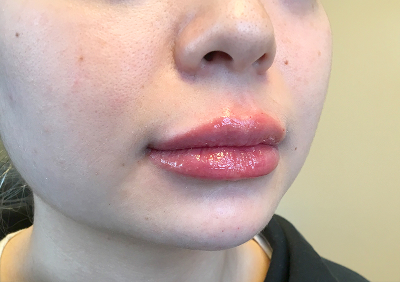 Injectables And Fillers 03