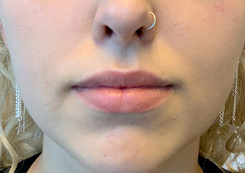 Injectables And Fillers 01