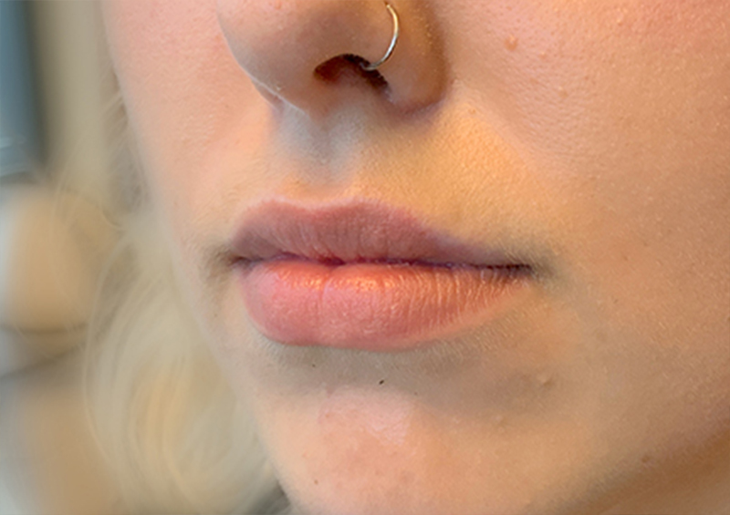 Injectables And Fillers 03