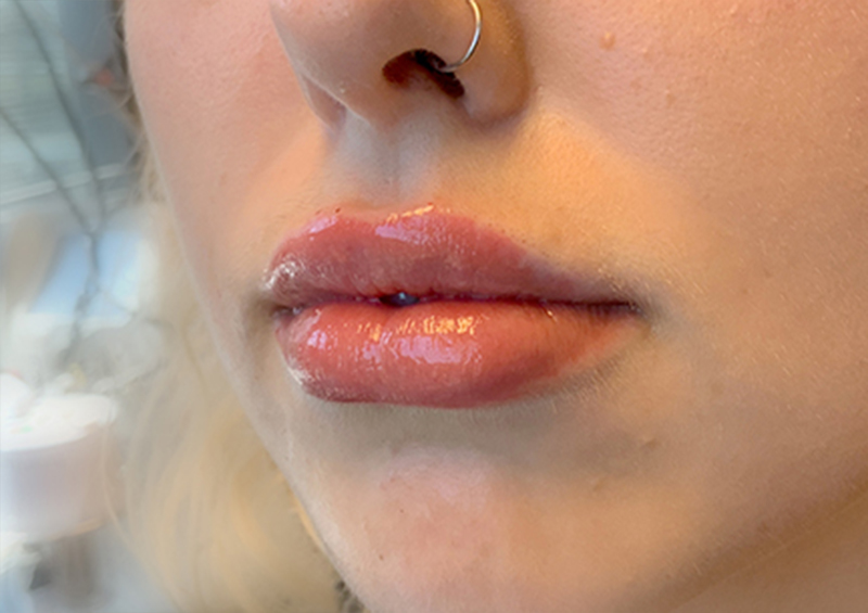 Injectables And Fillers 03