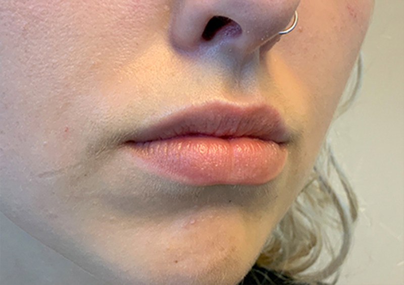 Injectables And Fillers 05