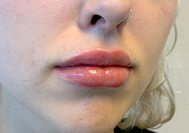 Injectables And Fillers 05