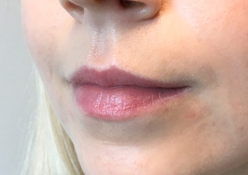 Injectables And Fillers 03