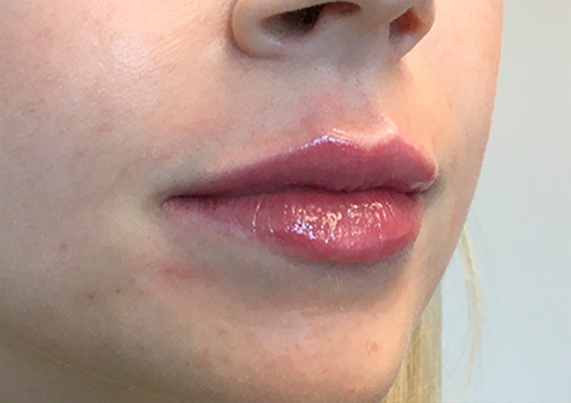 Injectables And Fillers 05