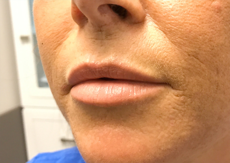 Injectables And Fillers 01