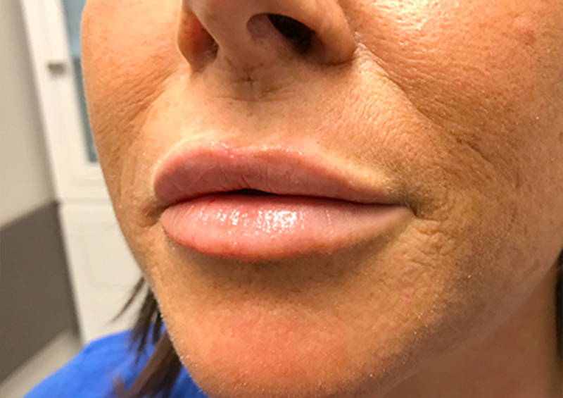 Injectables And Fillers 136