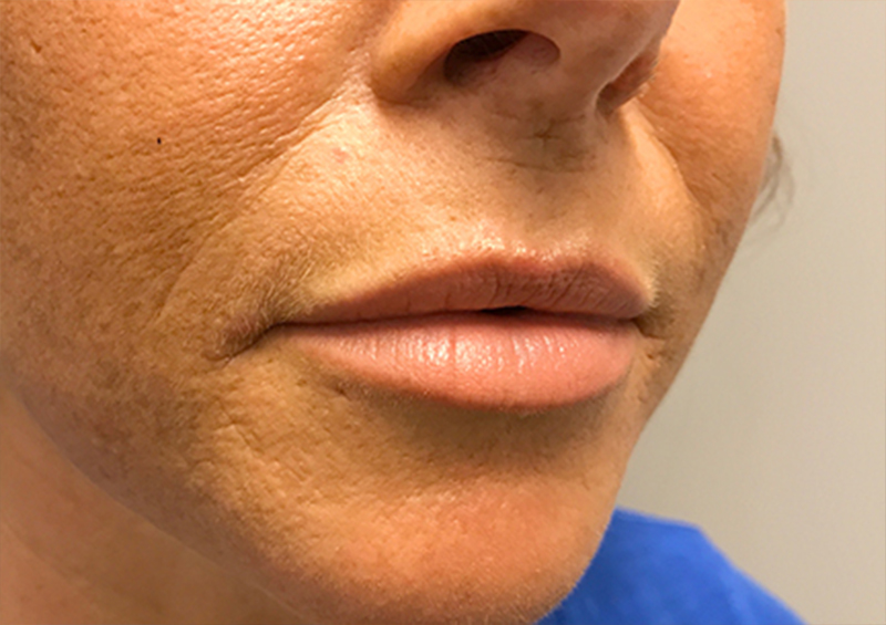 Injectables And Fillers 03