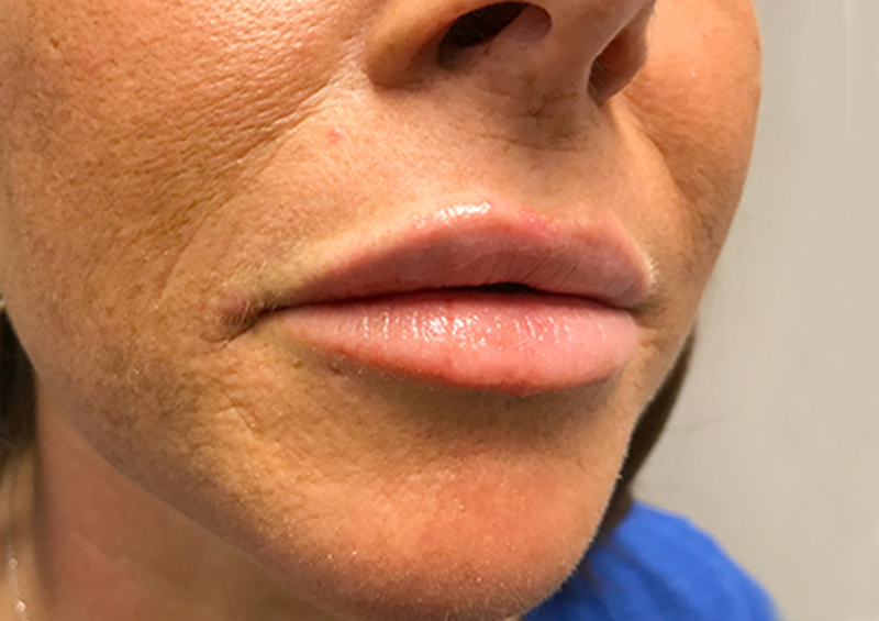 Injectables And Fillers 03