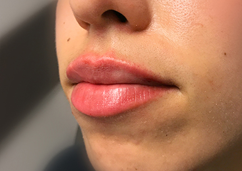 Injectables And Fillers 03