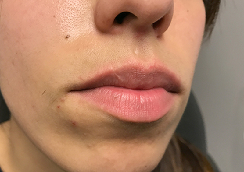 Injectables And Fillers 05