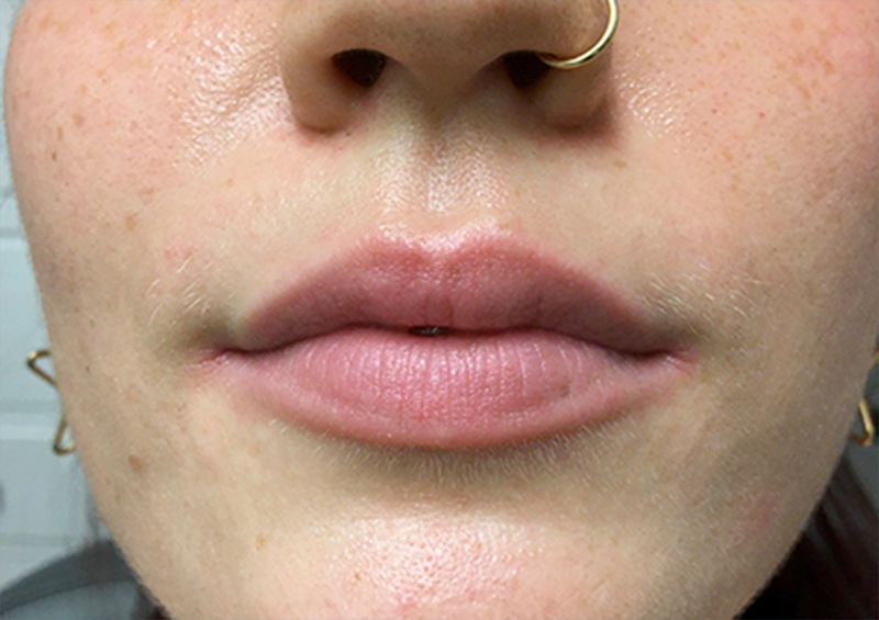 Injectables And Fillers 01