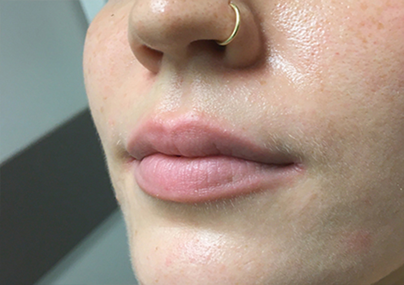 Injectables And Fillers 03