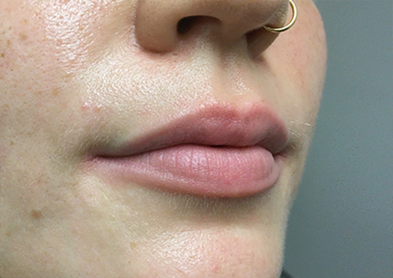 Injectables And Fillers 05