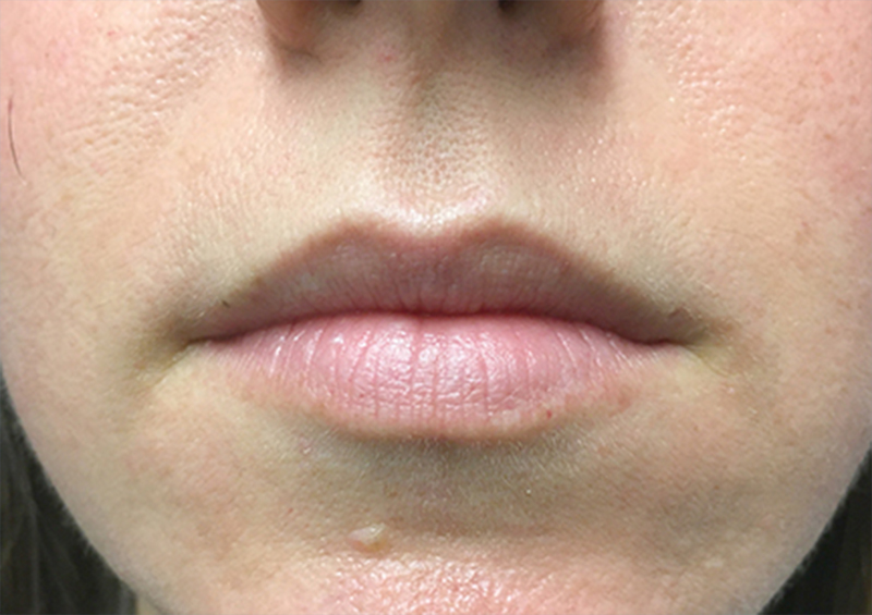 Injectables And Fillers 01