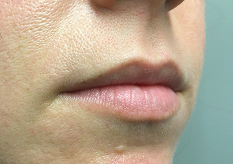 Injectables And Fillers 03