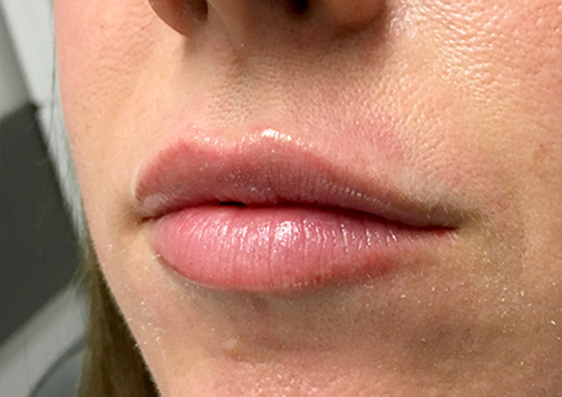 Injectables And Fillers 05