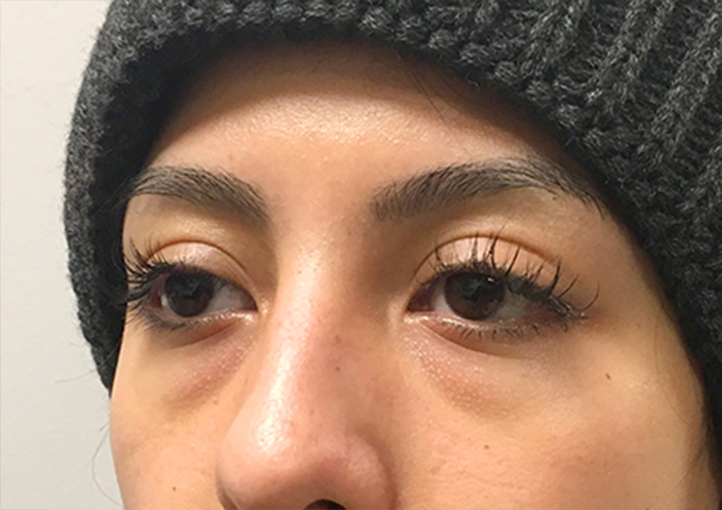 Injectables And Fillers 03