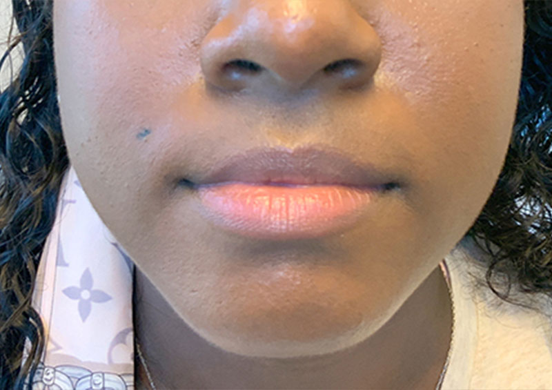 Injectables And Fillers 01