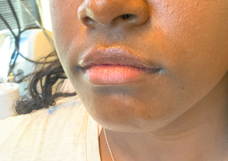 Injectables And Fillers 03