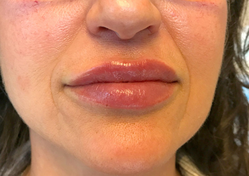 Injectables And Fillers 143