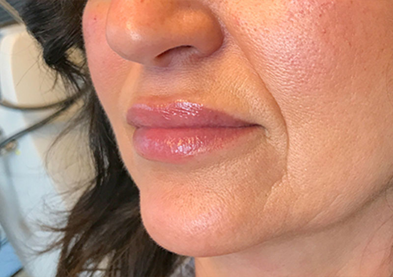 Injectables And Fillers 03