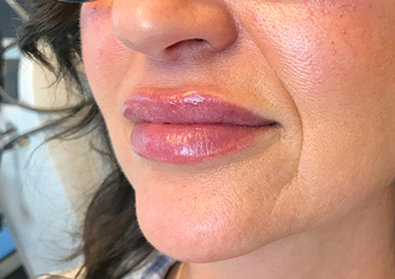 Injectables And Fillers 03