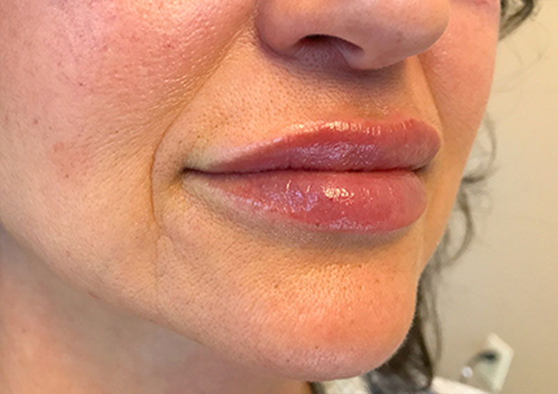 Injectables And Fillers 05