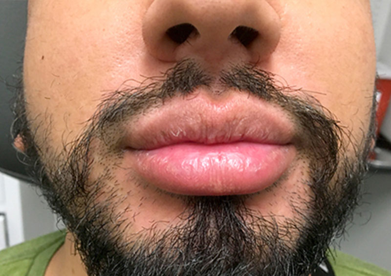 Injectables And Fillers 01