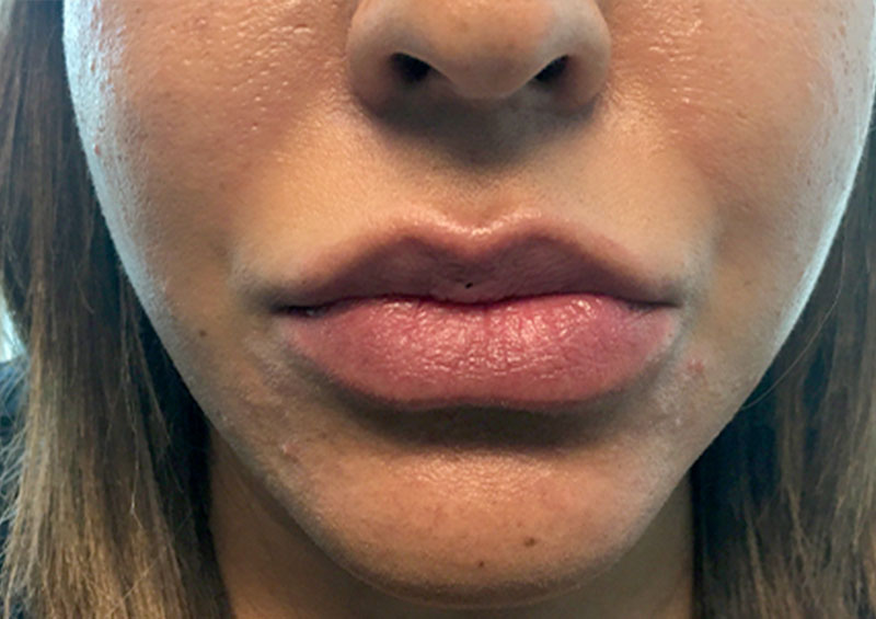 Injectables And Fillers 01