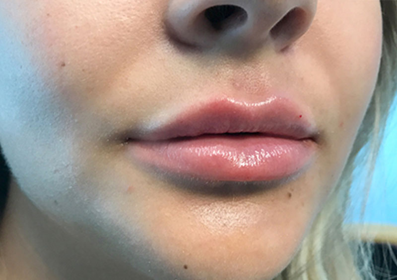 Injectables And Fillers 05