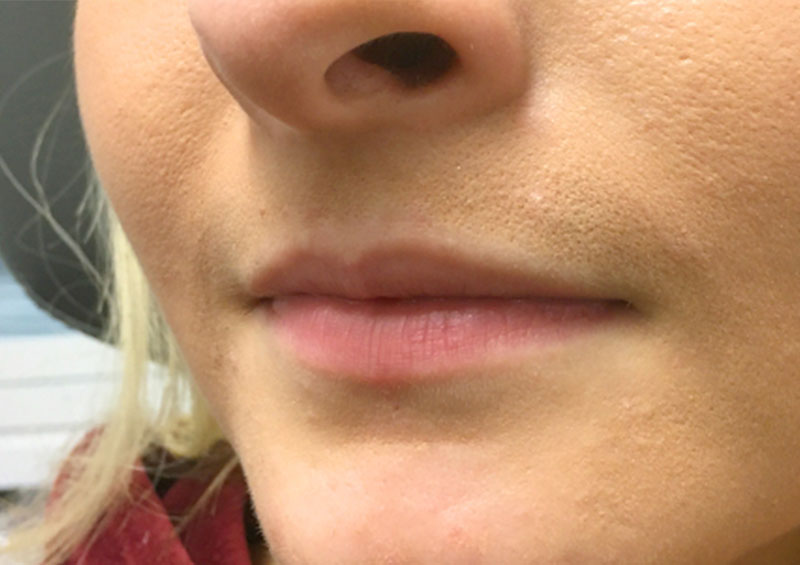 Injectables And Fillers 03