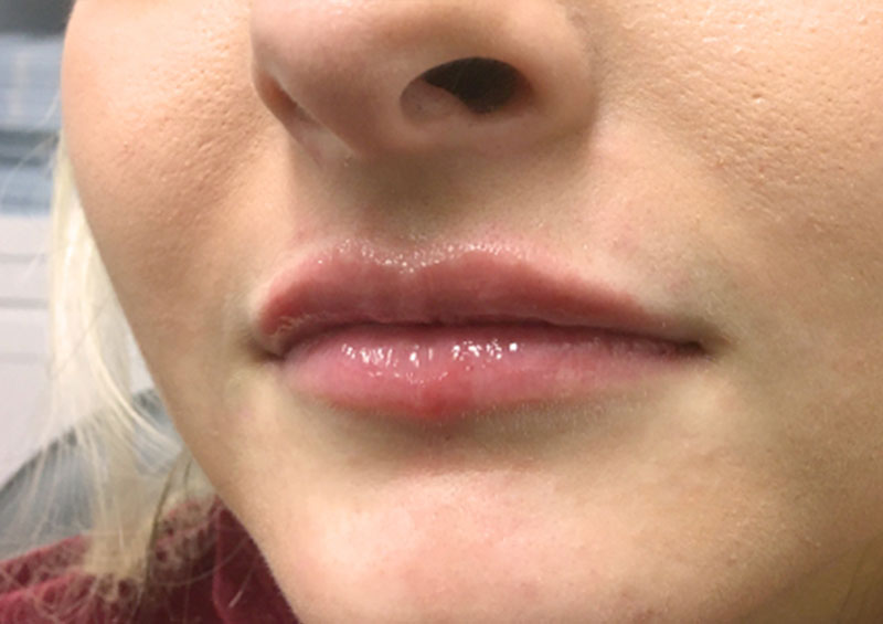 Injectables And Fillers 03