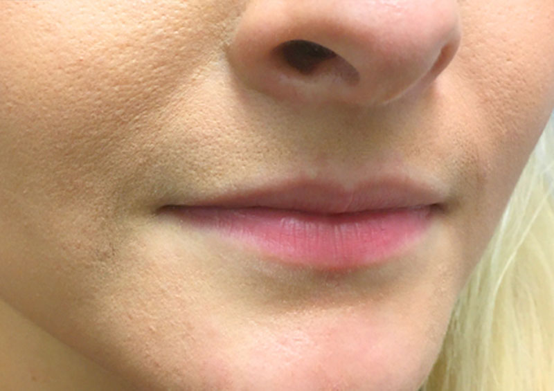 Injectables And Fillers 05