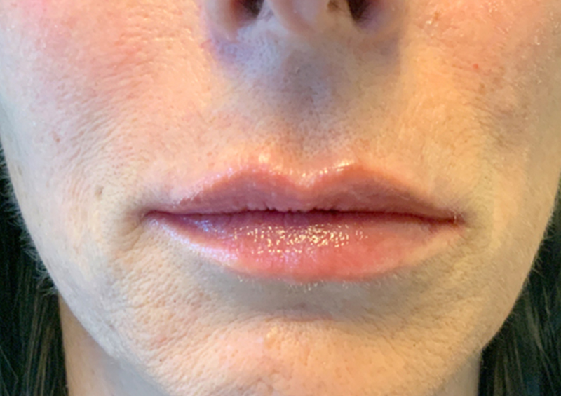 Injectables And Fillers 150