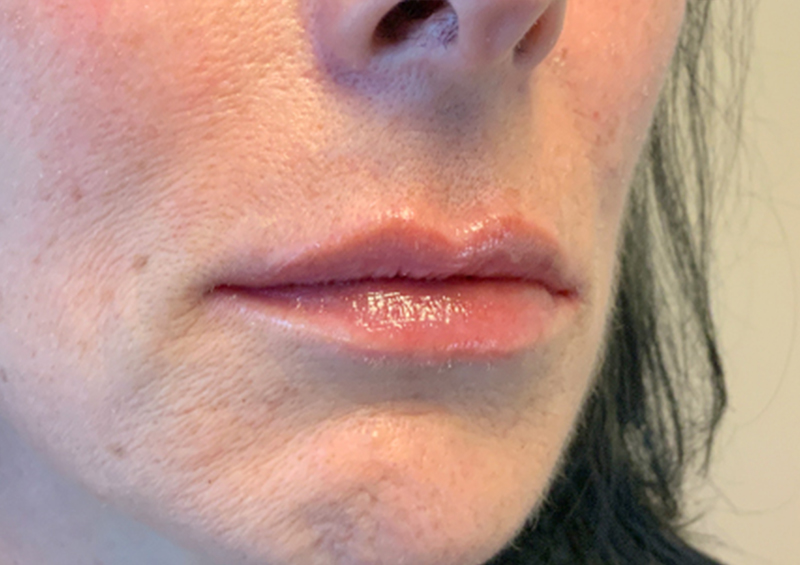 Injectables And Fillers 05