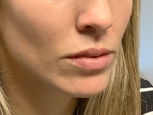 Injectables And Fillers 05