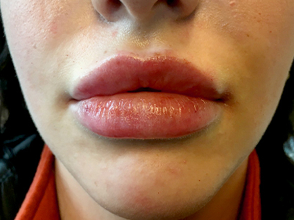 Injectables And Fillers 156