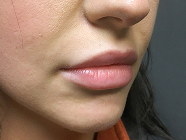 Injectables And Fillers 03