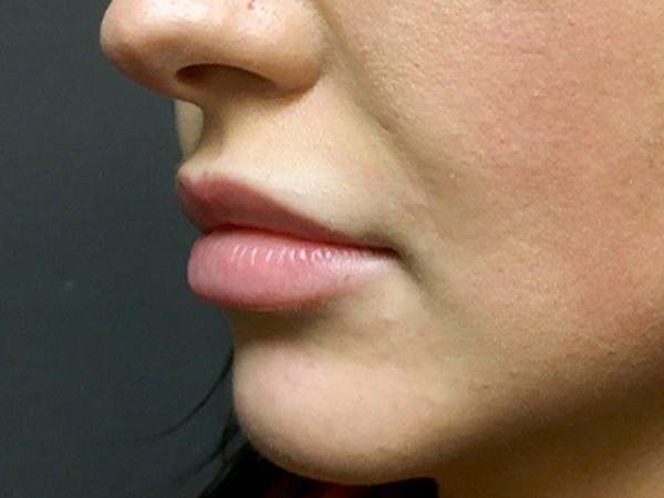 Injectables And Fillers 05