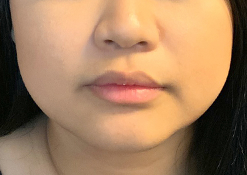 Injectables And Fillers 01