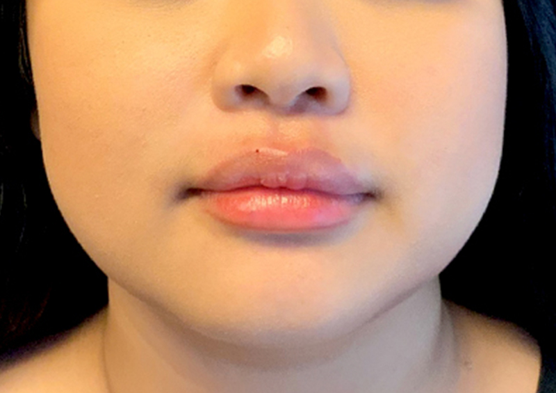 Injectables And Fillers 157