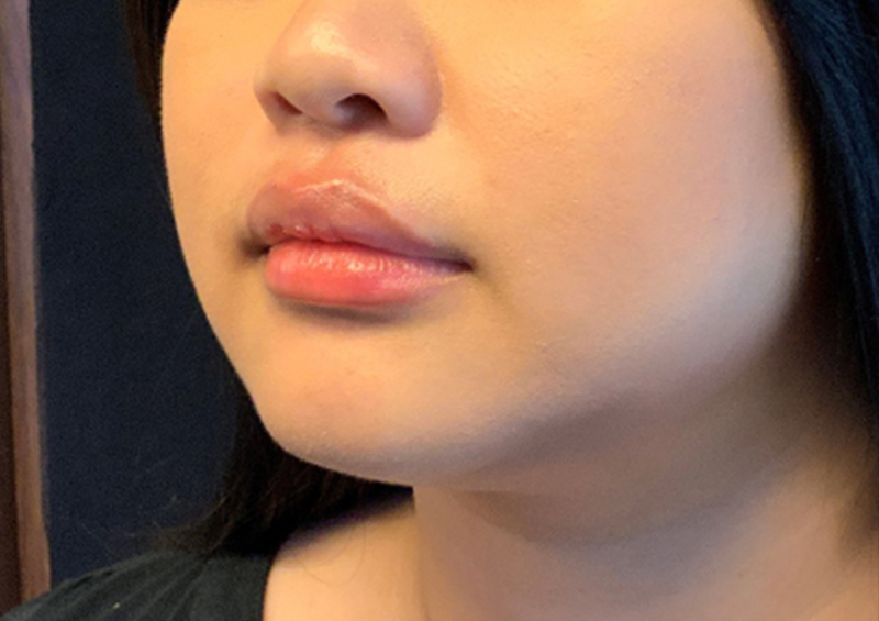 Injectables And Fillers 03