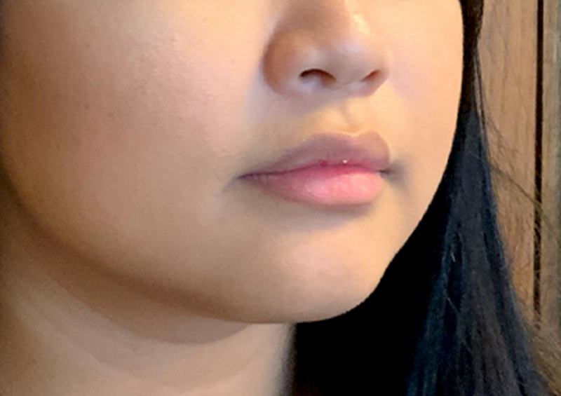 Injectables And Fillers 05