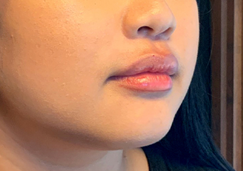 Injectables And Fillers 05