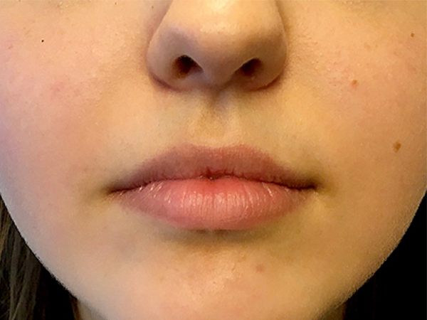 Injectables And Fillers 01